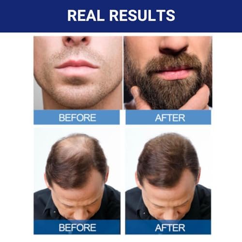 Kirkland Signature Minoxidil 5% Topical Solution for Men 1 Month Supply