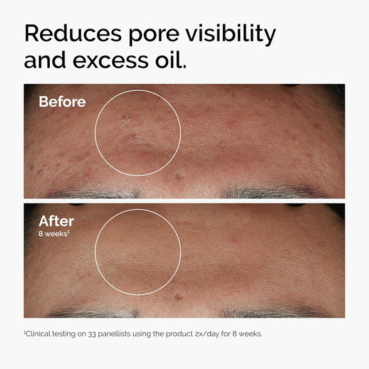 The Ordinary Niacinamide 10% Zinc 1% Face Serum 30 mL