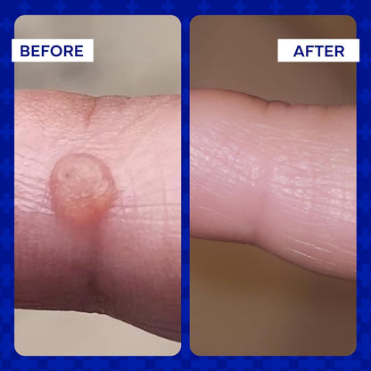 emuaid Ointment for Eczema & Psoriasis Relief – Reduces Itching, Pain & Swelling, Steroid-Free, 2oz