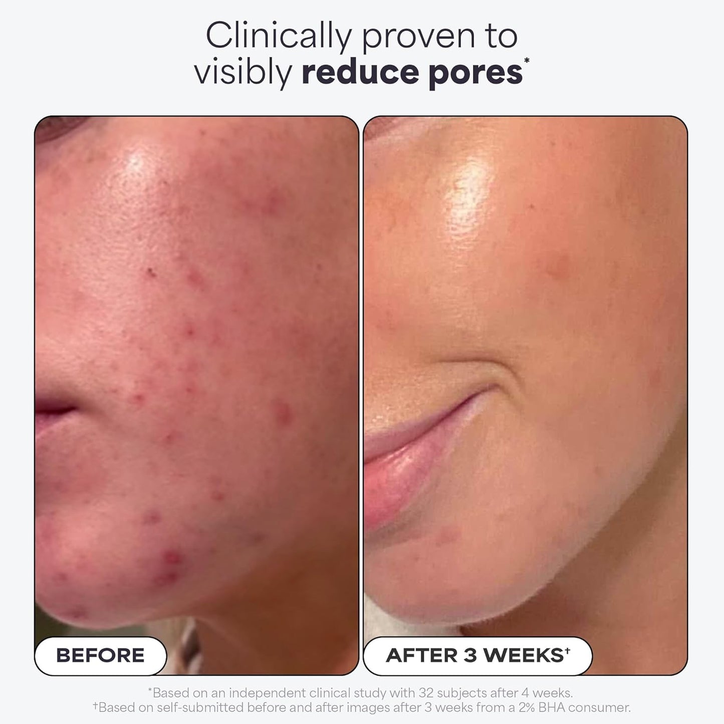Paula’s Choice Skin Perfecting 2% BHA Liquid Exfoliant – Salicylic Acid, Fragrance-Free, 118 ml