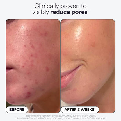 Paula’s Choice Skin Perfecting 2% BHA Liquid Exfoliant – Salicylic Acid, Fragrance-Free, 118 ml