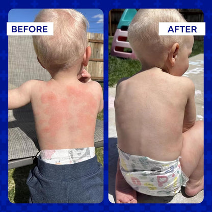emuaid Ointment for Eczema & Psoriasis Relief – Reduces Itching, Pain & Swelling, Steroid-Free, 2oz